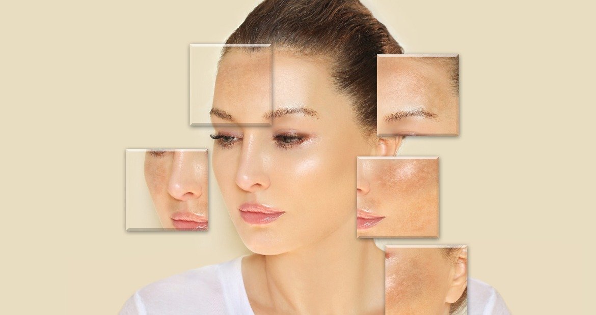 Mulher com manchas de melasma no rosto
